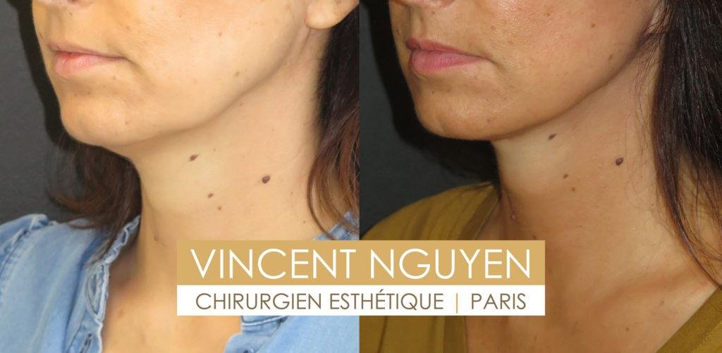 Comparaison des Résultats ⁤Esthétiques : Chirurgie du Cou versus Traitement‌ du⁢ Double​ Menton