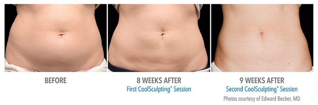 CoolSculpting