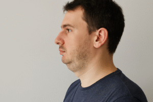 Recul du menton (rétrognathie) : pourquoi il crée un faux double menton